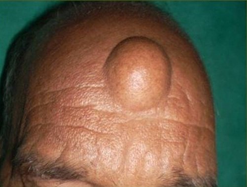 Before Lipoma Treatment