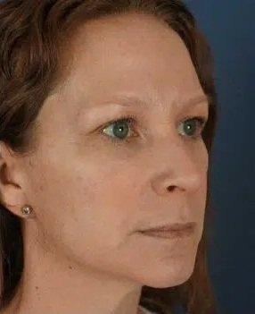 After Cosmetic Surgery