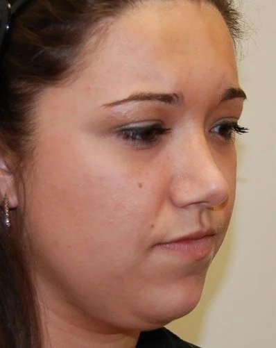 Before Double Chin Treatment