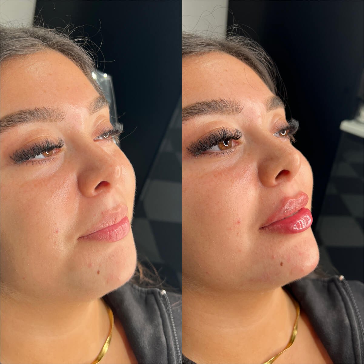 Lip Fillers in Multan for Proportionate Shape and Volume treatment at Le Pearl Aesthetic Clinic