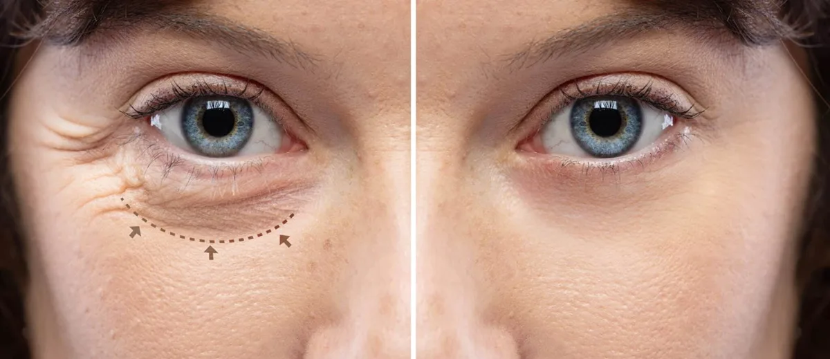 Blepharoplasty