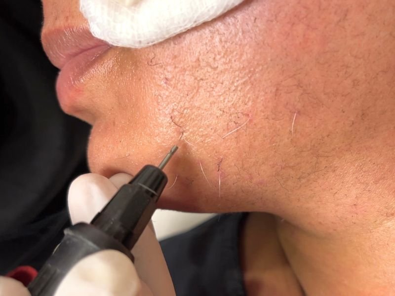 Electrolysis Hair Removal in Multan for Individual Hairs treatment at Le Pearl Aesthetic Clinic