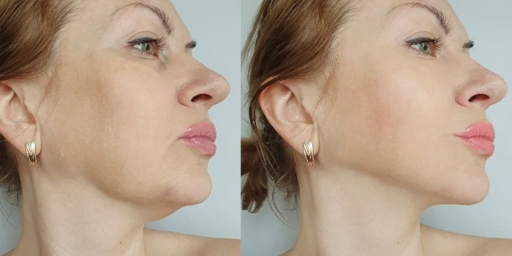 Double Chin Treatment in Multan Based on Anatomy treatment at Le Pearl Aesthetic Clinic
