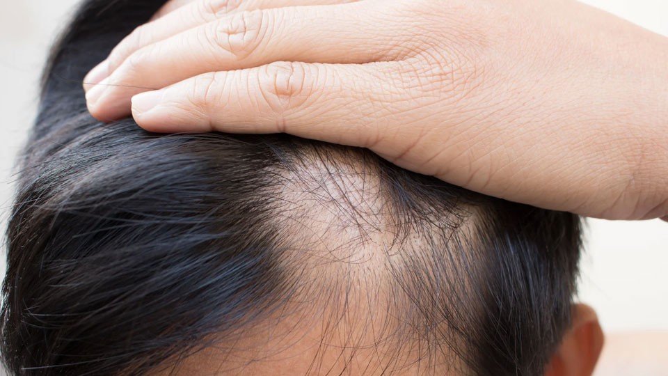 Hair Loss Treatment in Multan Starts with a Diagnosis treatment at Le Pearl Aesthetic Clinic
