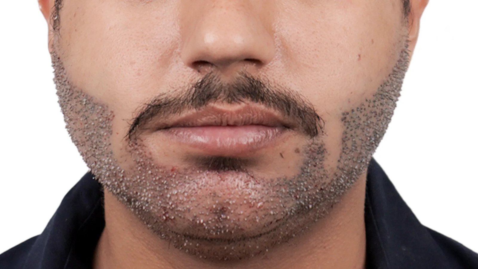 Natural-Looking Beard Transplant in Multan treatment at Le Pearl Aesthetic Clinic
