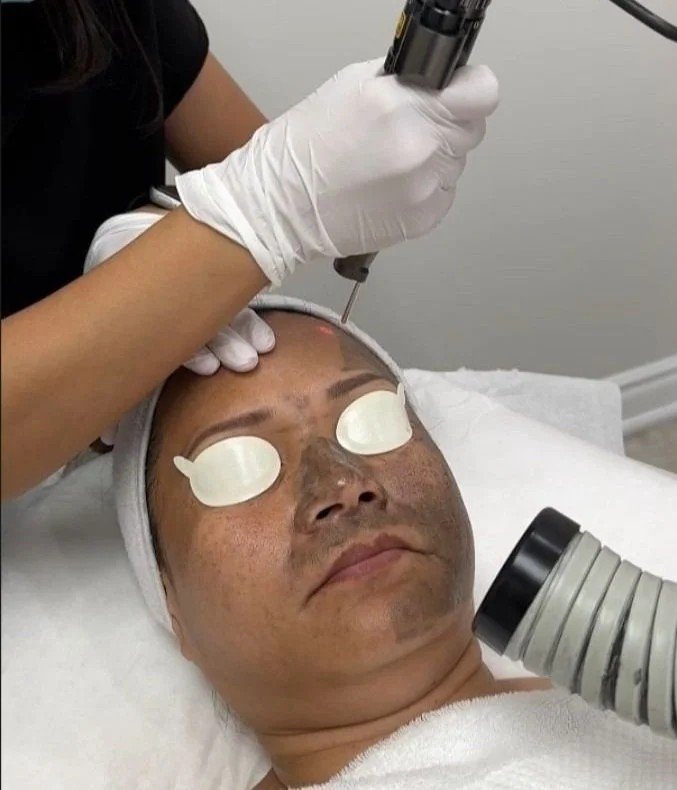 Melasma Treatment in Multan for Recurring Facial Patches treatment at Le Pearl Aesthetic Clinic