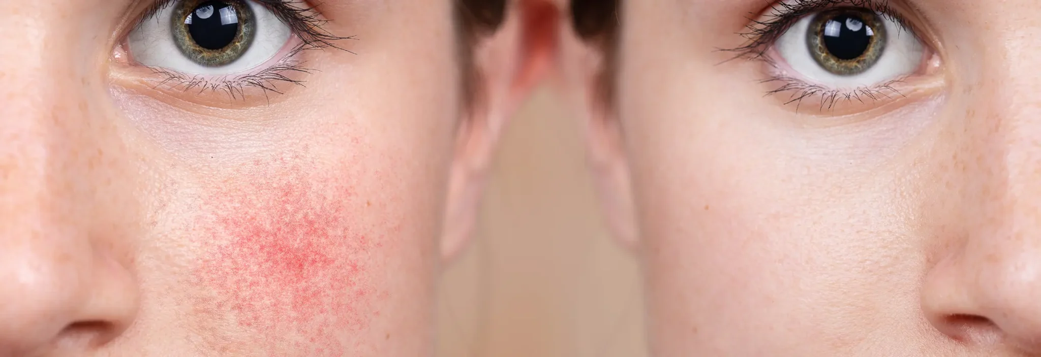 Rosacea Treatment in Multan for Flushing and Redness treatment at Le Pearl Aesthetic Clinic